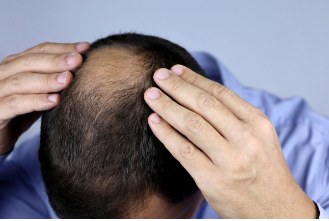 Does Shilajit Stop Hair Loss? What Science Says